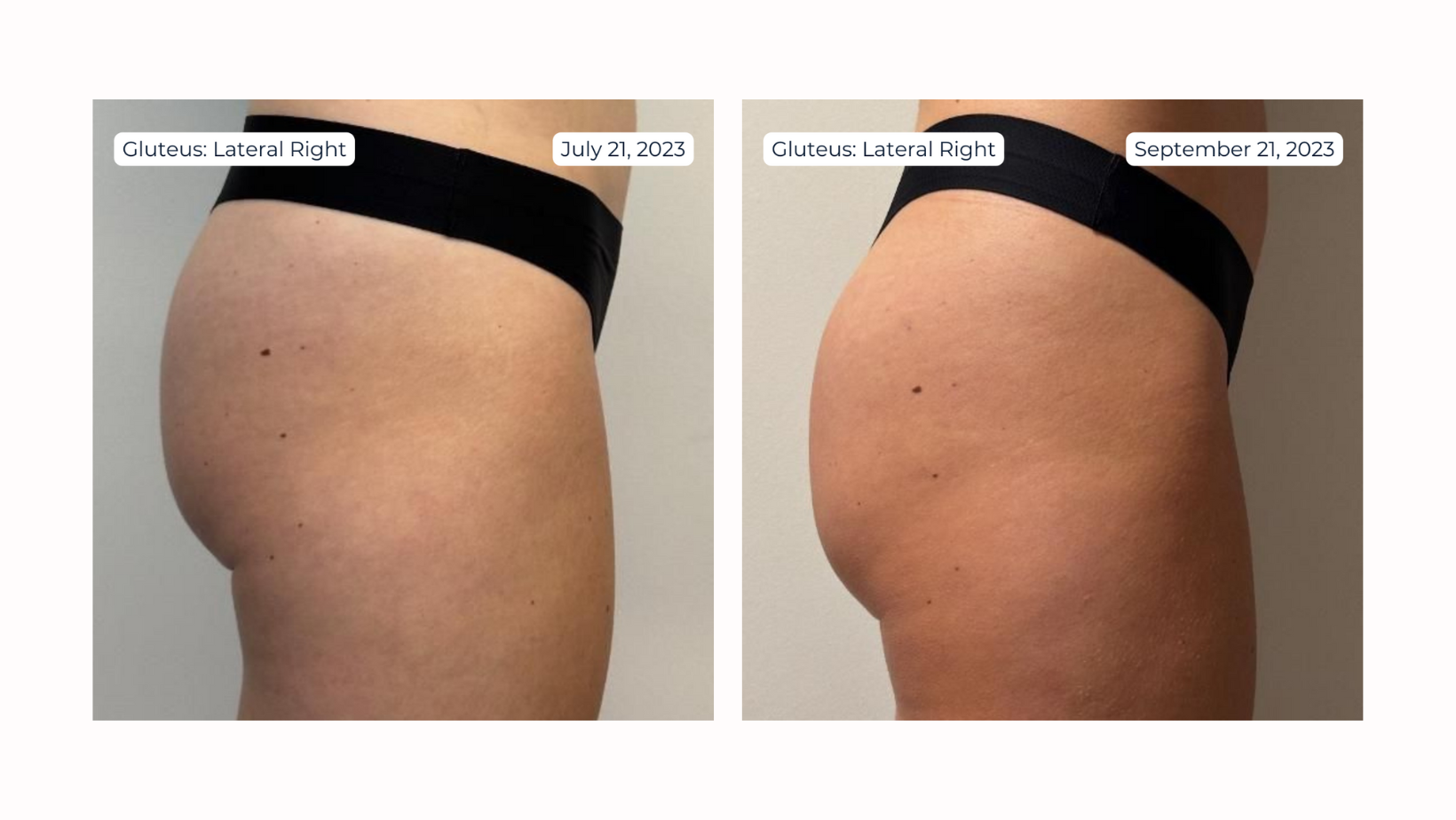 Non-Surgical BBL Bundle with Radiesse