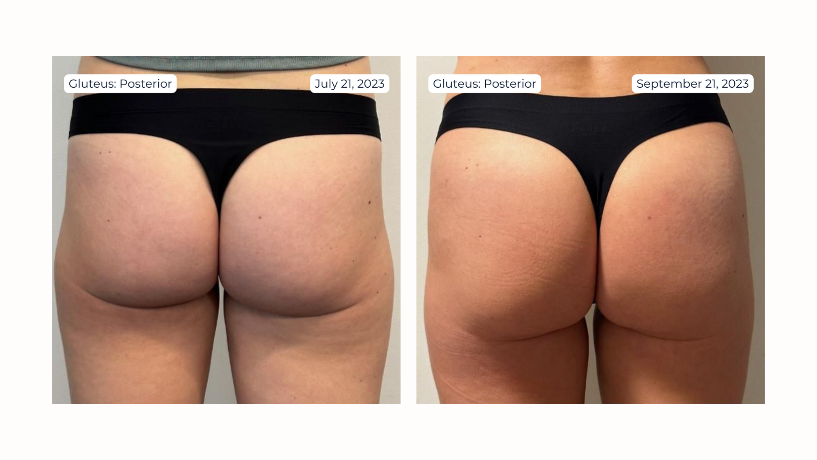 Non-Surgical BBL Bundle with Radiesse