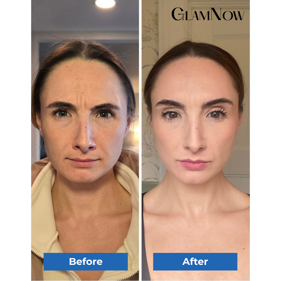 Xeomin (50 units/vial)